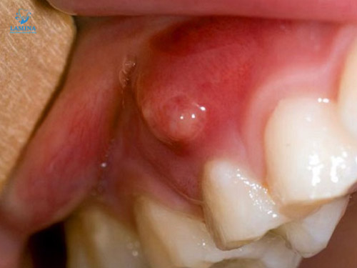 dấu hiệu viêm tuỷ răng cấp: nướu sưng đỏ