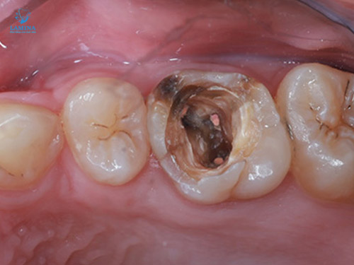dấu hiệu viêm tuỷ răng cấp: xuất hiện lỗ sâu lớn