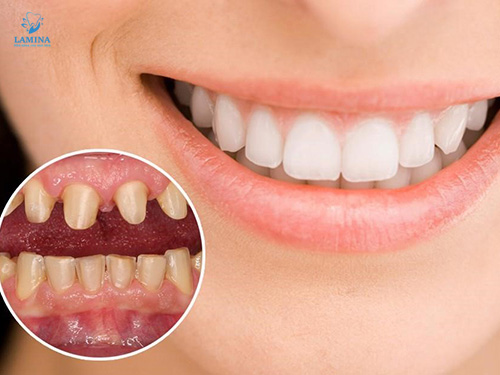 địa chỉ bọc răng sứ đông anh