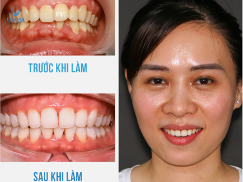 địa chỉ bọc răng sứ đông anh: cảm nhận khách hàng