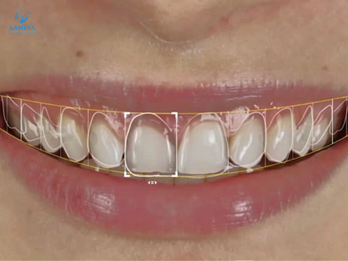 địa chỉ bọc răng sứ đông anh: công nghệ thiết kế nụ cười