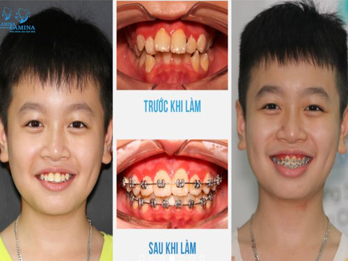 niềng răng uy tín đông anh