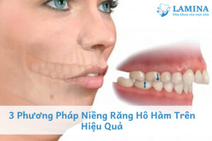 Phương pháp niềng răng hô hàm trên hiệu quả