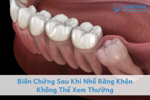 Biến Chứng Sau Khi Nhổ Răng Khôn Không Thể Xem Thường
