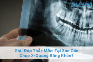 Tại sao cần chụp X-quang răng khôn?