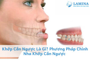 Khớp cắn ngược là gì? Phương pháp chỉnh nha khớp cắn ngược