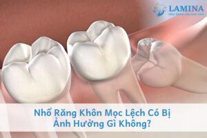 Nhổ răng khôn mọc lệch có bị ảnh hưởng gì không?