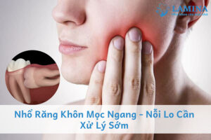 Nhổ răng khôn mọc ngang - Nỗi lo cần được xử lý sớm