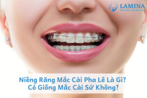 Niềng răng mắc cài pha lê là gì? Có giống mắc cài sứ không?
