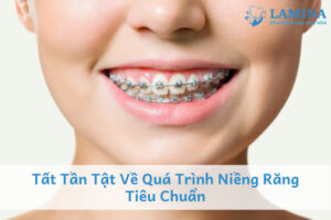 Quá trình niềng răng tiêu chuẩn bạn cần biết