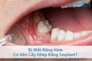 Bị mất răng hàm có nên cấy ghép răng implant?