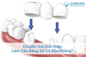 Chuyên gia giải đáp: làm cầu răng sứ có bền không?