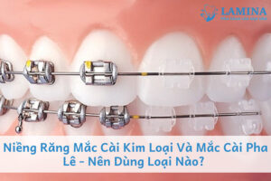 Niềng răng mắc cài kim loại và mắc cài pha lê - nên dùng loại nào?