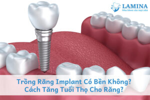 Trồng răng implant có bền không? Cách tăng tuổi thọ cho răng?