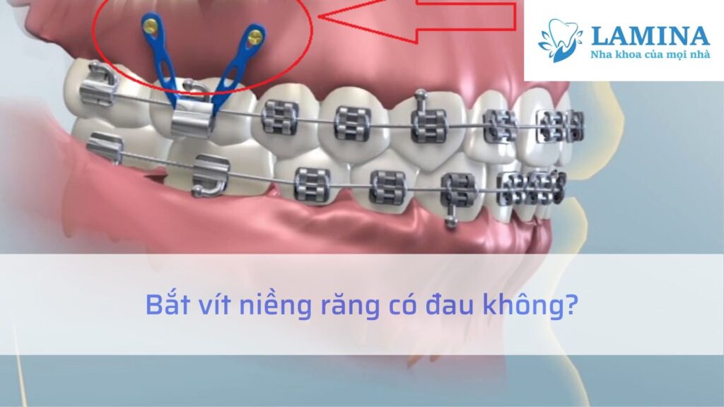 bắt vít niềng răng có đau không?