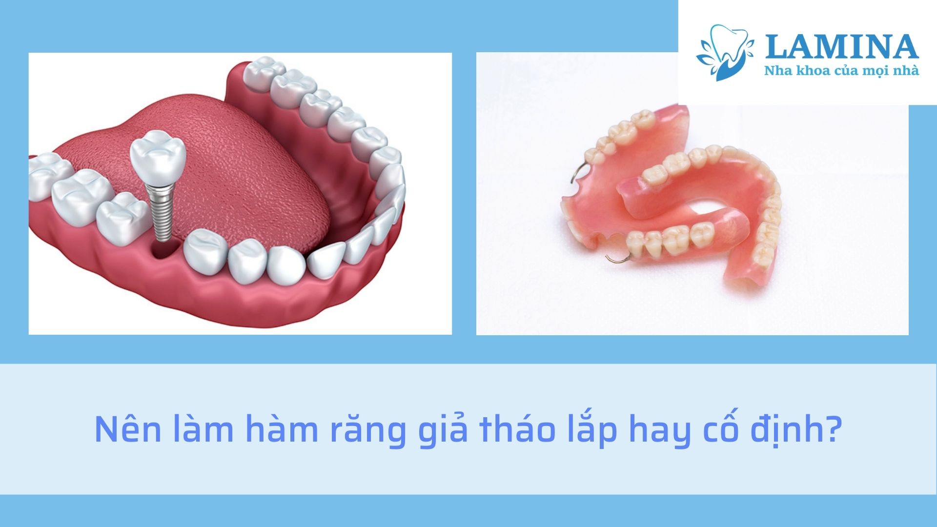 Nên Làm Hàm Răng Giả Tháo Lắp Hay Cố định?