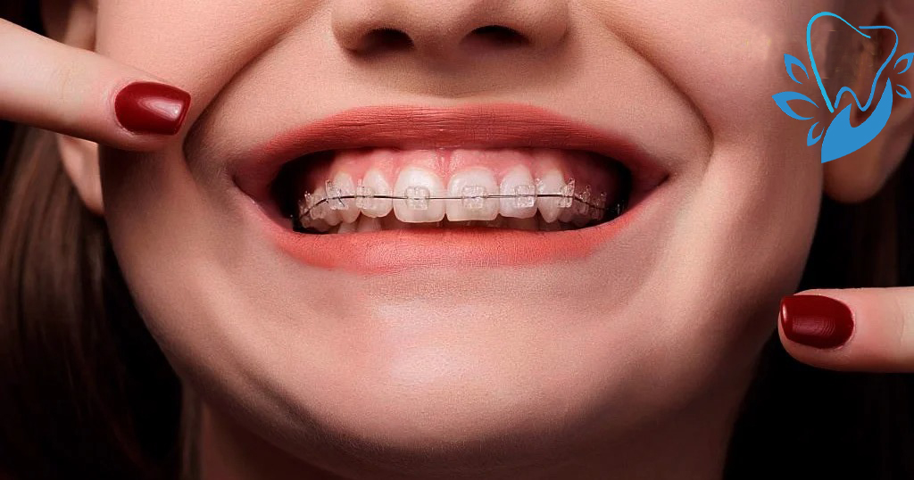 Niềng răng mắc cài là gì?