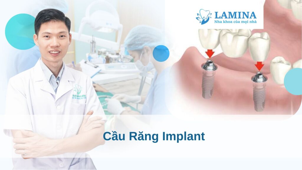 Cầu răng Implant
