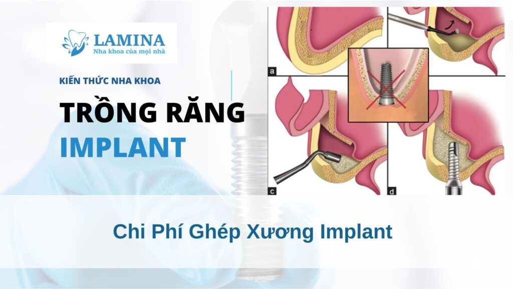 Chi phí ghép xương Implant