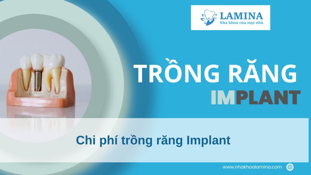 Chi phí trồng răng Implant