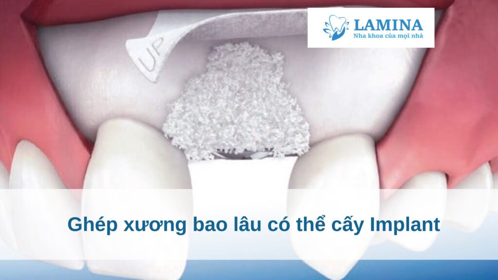 Ghép xương bao lâu có thể cấy Implant