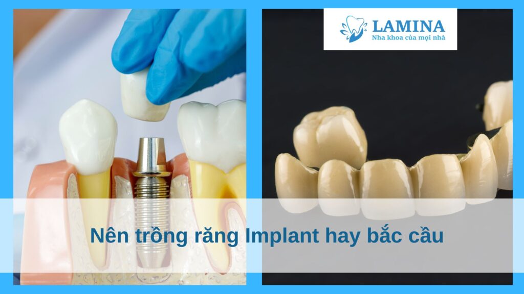 Nên trồng răng Implant hay bắc cầu