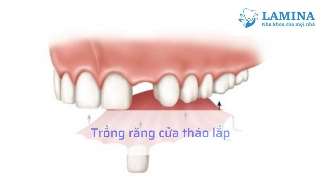Trồng răng cửa tháo lắp