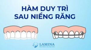 Hàm duy trì sau niềng