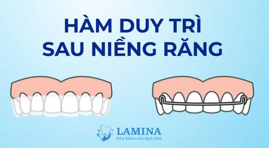 Hàm duy trì sau niềng