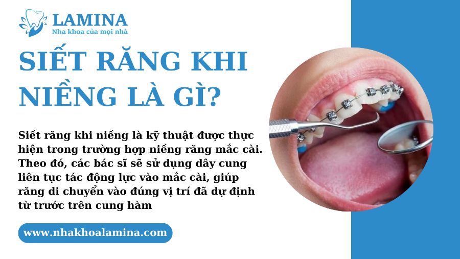 Siết răng khi niềng