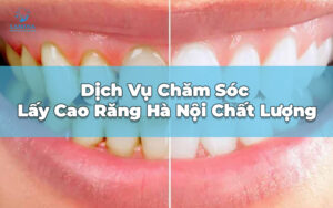 lấy cao răng hà nội