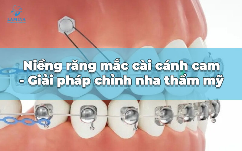 niềng răng mắc cài cánh cam