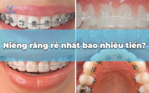 niềng răng rẻ nhất bao nhiêu tiền