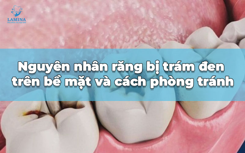 bìa răng bị đen bề mặt