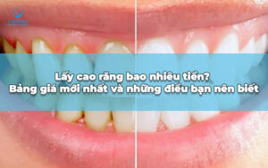 lấy cao răng bao nhiều tiền