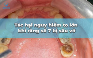 răng số 7 bị sâu vỡ
