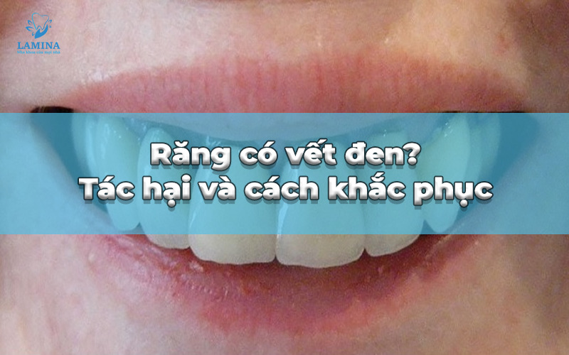 Răng có vết đen