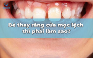 răng cửa mọc lệch