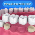 Răng giả bao nhiêu tiền? Cập nhật chi tiết chi phí & lời khuyên từ bác sĩ