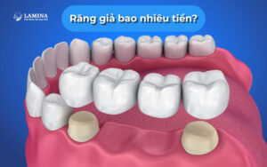 Răng giả bao nhiêu tiền? Cập nhật chi tiết chi phí & lời khuyên từ bác sĩ