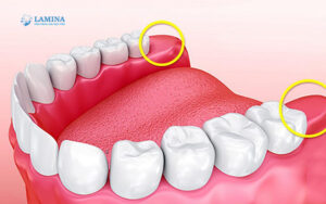 Răng khôn là răng ở đâu Vì sao ai cũng sợ mọc răng khôn