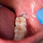 Nhổ răng khôn 2 tháng vẫn đau – cảnh báo bất thường bạn không nên bỏ qua