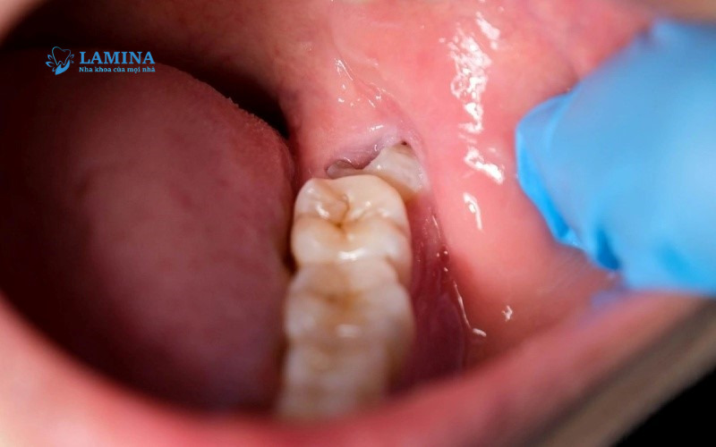 Nhổ răng khôn 2 tháng vẫn đau – cảnh báo bất thường bạn không nên bỏ qua