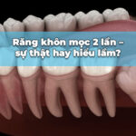 răng khôn mọc 2 lần