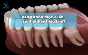 răng khôn mọc 2 lần