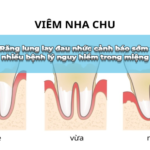 răng lung lay đau nhức