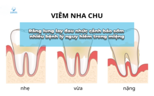 răng lung lay đau nhức