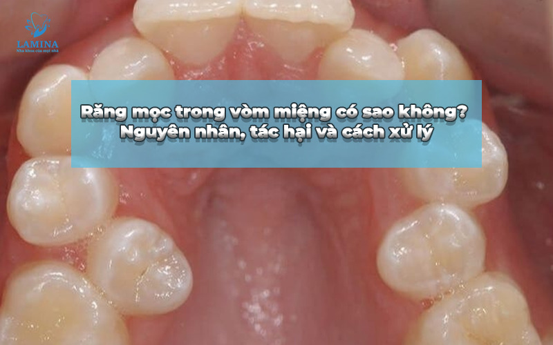 răng mọc trong vòm miệng