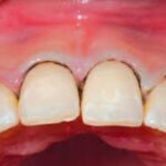 Viêm nha chu nặng