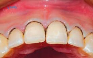 Viêm nha chu nặng